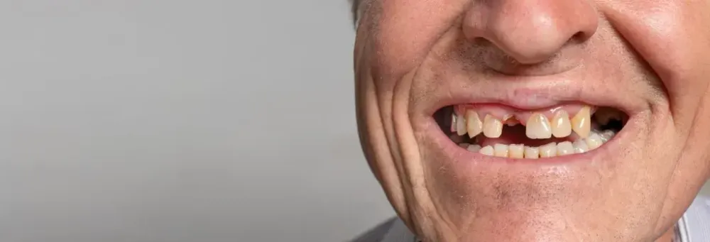 missing tooth 1