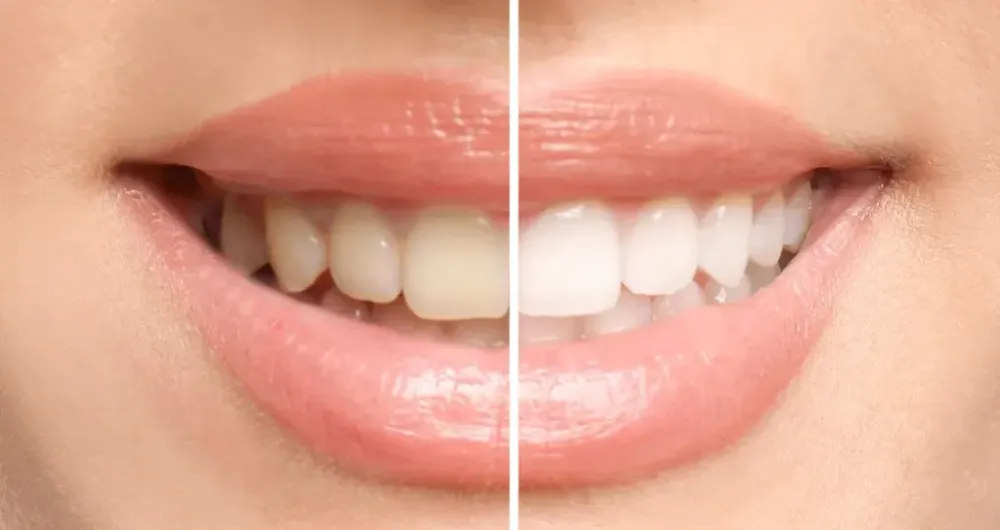 yellow teeth 1