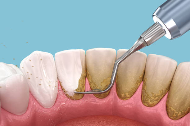 a photo showing how teeth is cleaned using a dental scaler
