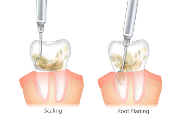 image showing a teeth scaling and root planning procedure